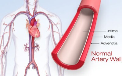 What is Atherosclerosis?